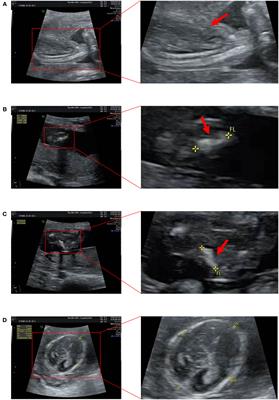 Case Report: A novel de novo variant of COL1A1 in fetal genetic osteogenesis imperfecta